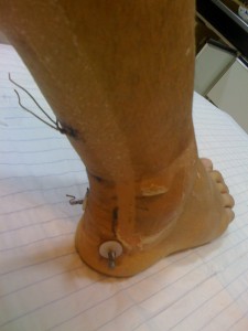 Opération du tendon Opération du tendon